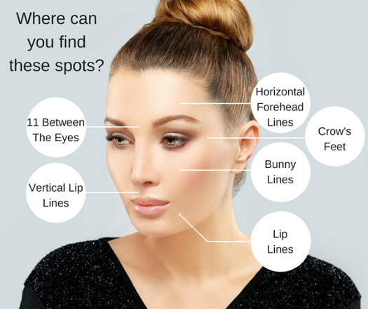 Illustration identifying problem areas on woman\'s face that botox treats