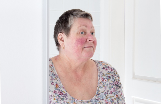 Woman with rosacea looking into mirror