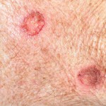 skin with actinic keratosis