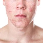 adolescent face with acne vulgaris