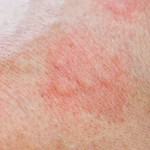 skin with contact dermatitis