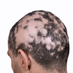 scalp with alopecia areata