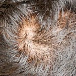 scalp showing hair loss