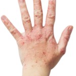 back of a hand with dermatitis