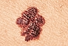 A brownish-red patch of skin with irregular, uneven borders often associated with some forms of skin cancer.