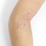 Rough, scaly, and reddened dry skin on the inner area of a person\'s elbow.