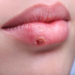 A red and yellow blister on a woman\'s lips.