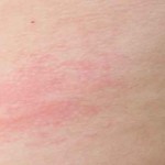 Close-up view of a red welt on the skin known as hives.