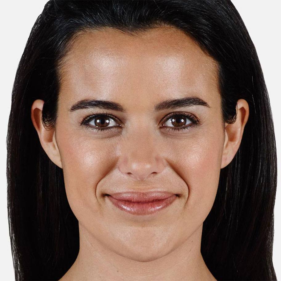 Before Juvederm injections