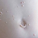 Small bumps related to mulluscum contagiosum cover the skin around the bellybutton and abdomen.