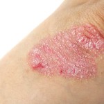 A close-up view of a scaly psoriasis skin patch.