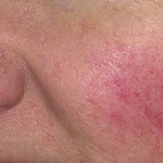 Close-up view of a person\'s cheek that has many the small visible veins and redness that are typical of rosacea.