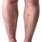 Close-up of a man\'s calves showing the red spots from scabies.