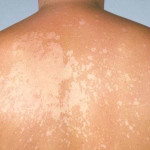 View of a patient\'s back covered with light-colored patches from the fungal infection tinea versicolor.