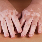The back of a patient\'s hands showing the patchy loss of pigment typical of vitiligo.
