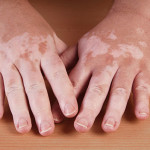 The back of a patient\'s hands showing the patchy loss of pigment typical of vitiligo.