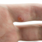 Close-up view of a wart on a patient\'s finger.
