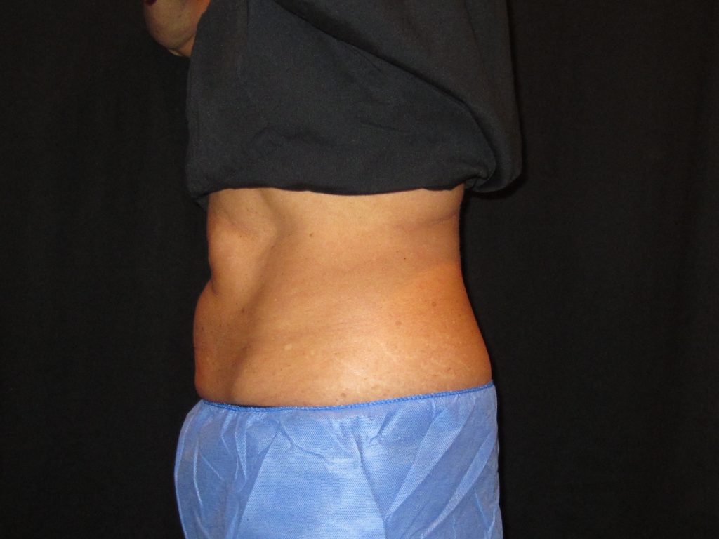 After coolsculpting