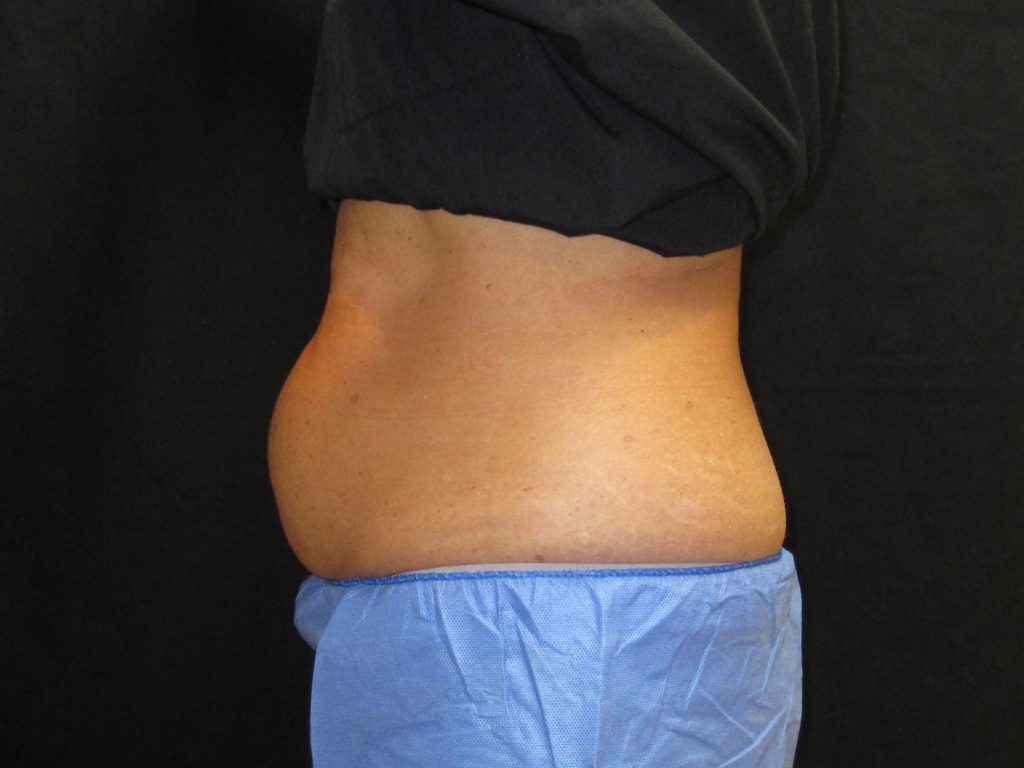 Before Coolsculpting