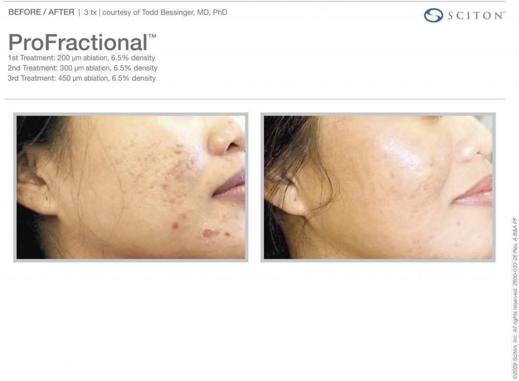 Female Patient Before and After ProFractional Therapy