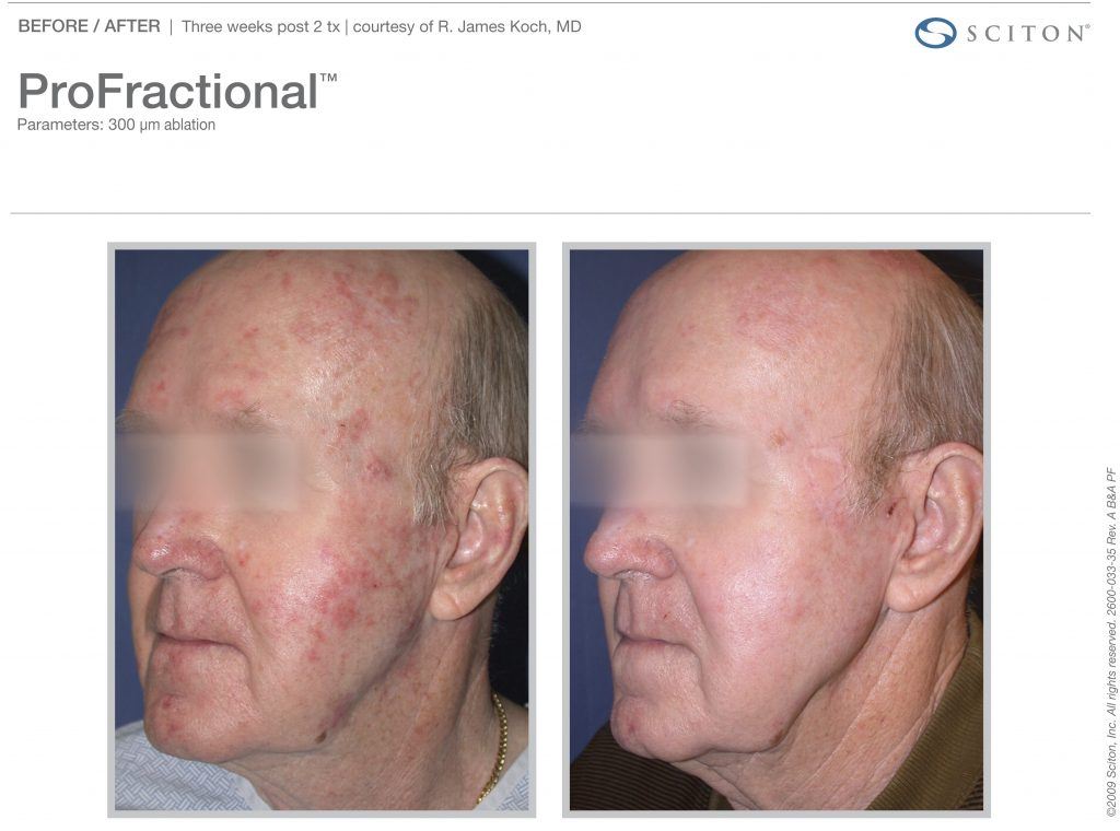 Male Patient Before and After ProFractional Therapy