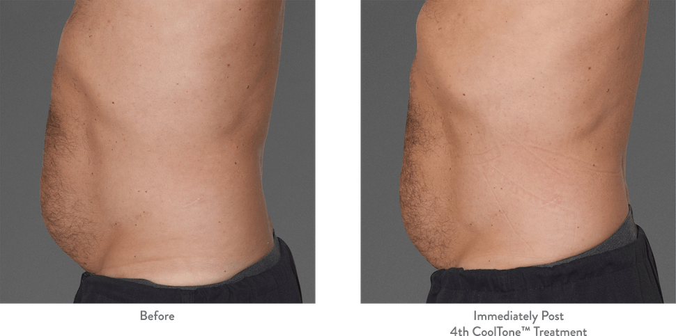 Side view of man’s abdomen before and after Cooltone. The after photo shows a flatter, less rounded belly.