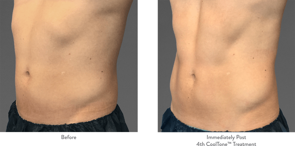 Close-up of male midsection before and after CoolTone, with strong abdominal definition in the after photo.
