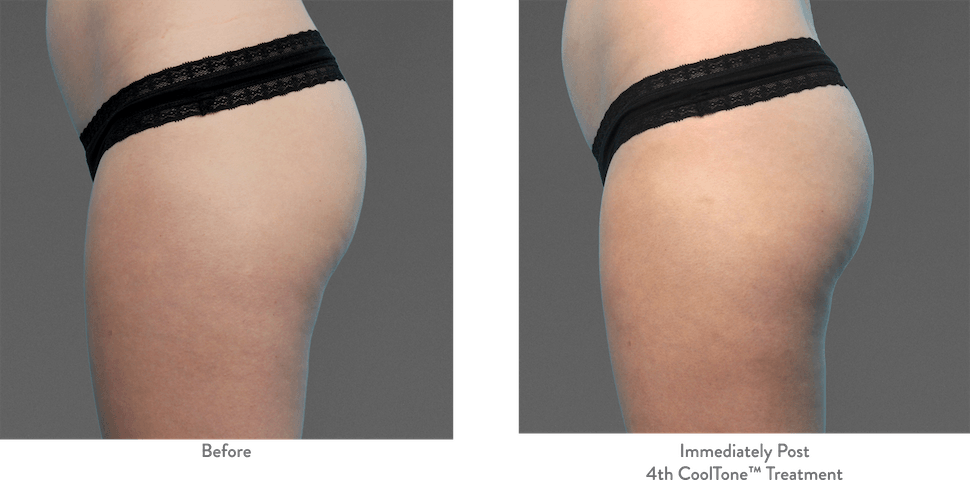 Side view of buttocks and upper thighs before and after CoolTone, showing more definition between butt cheek and thigh.