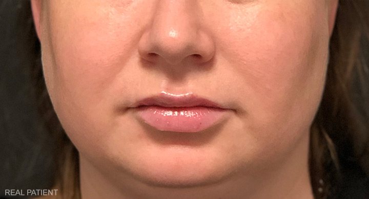 After Lip Filler