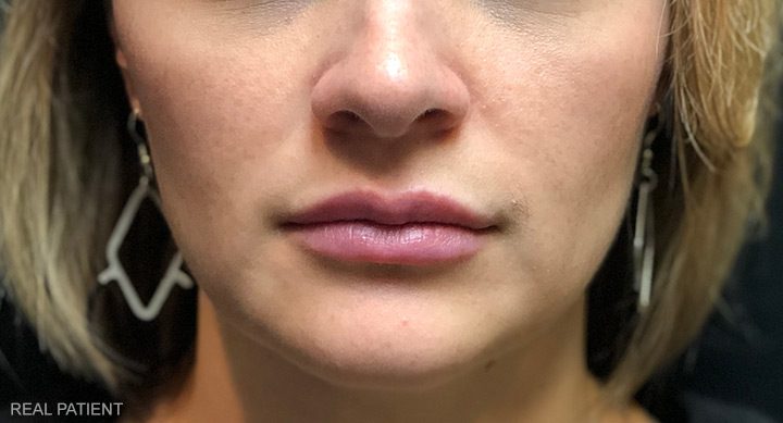 After Lip Filler