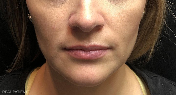 Before Lip Filler