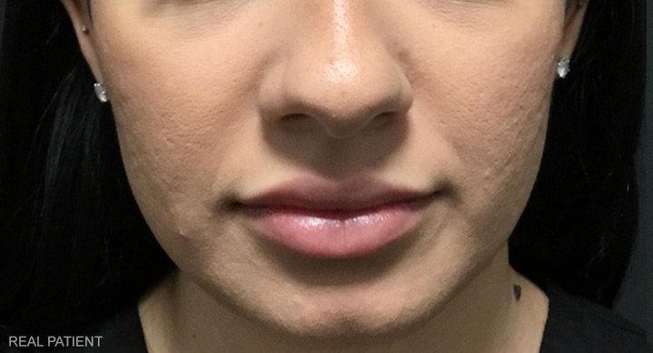 After Lip Filler