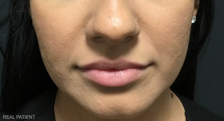 Before Lip Filler