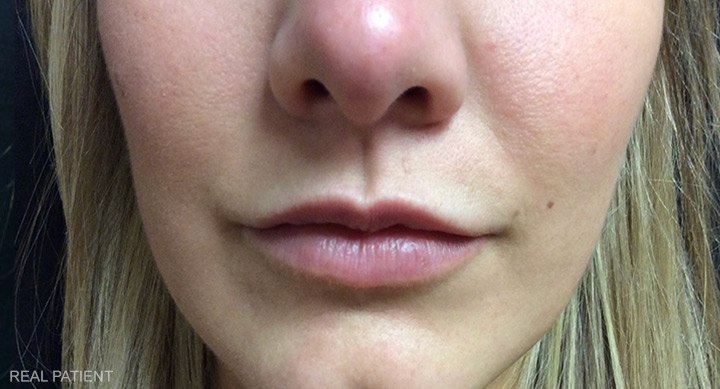 After Lip Filler