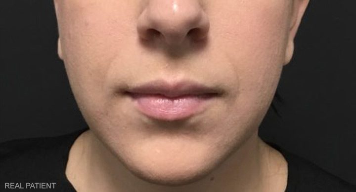 Before Lip Filler