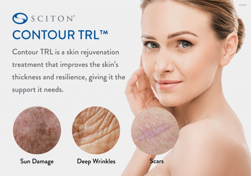 Contour TRL is a skin rejuvenation treatment that improves the skin's thickness and resilience, giving it the support it needs. This treatment tackles skin conditions such as sun damage, deep wrinkles, and scars.