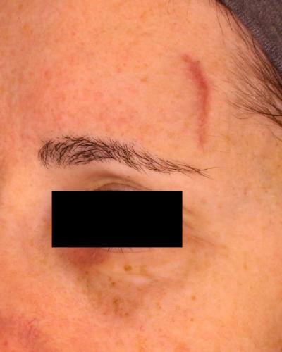 VBeam Prima Scar Treatment