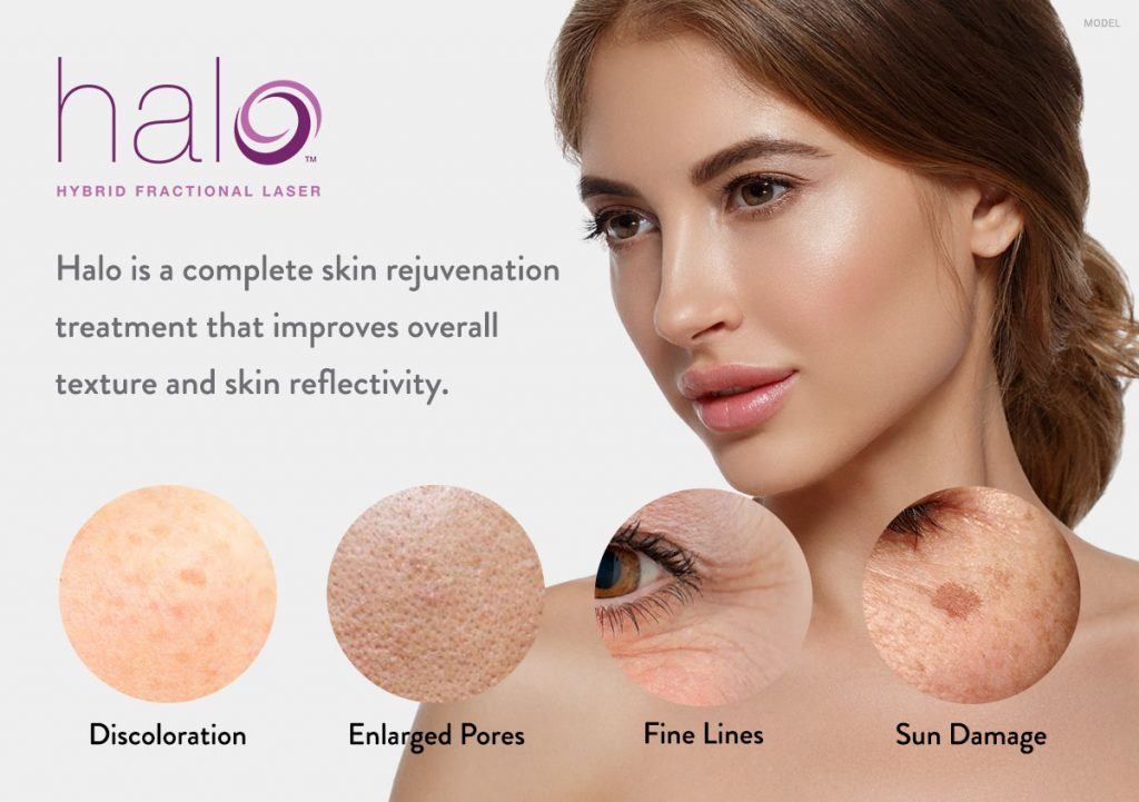 Halo is a complete skin rejuvenation treatment that improves skin conditions such as discoloration, enlarged pores, fine lines, and sun damage