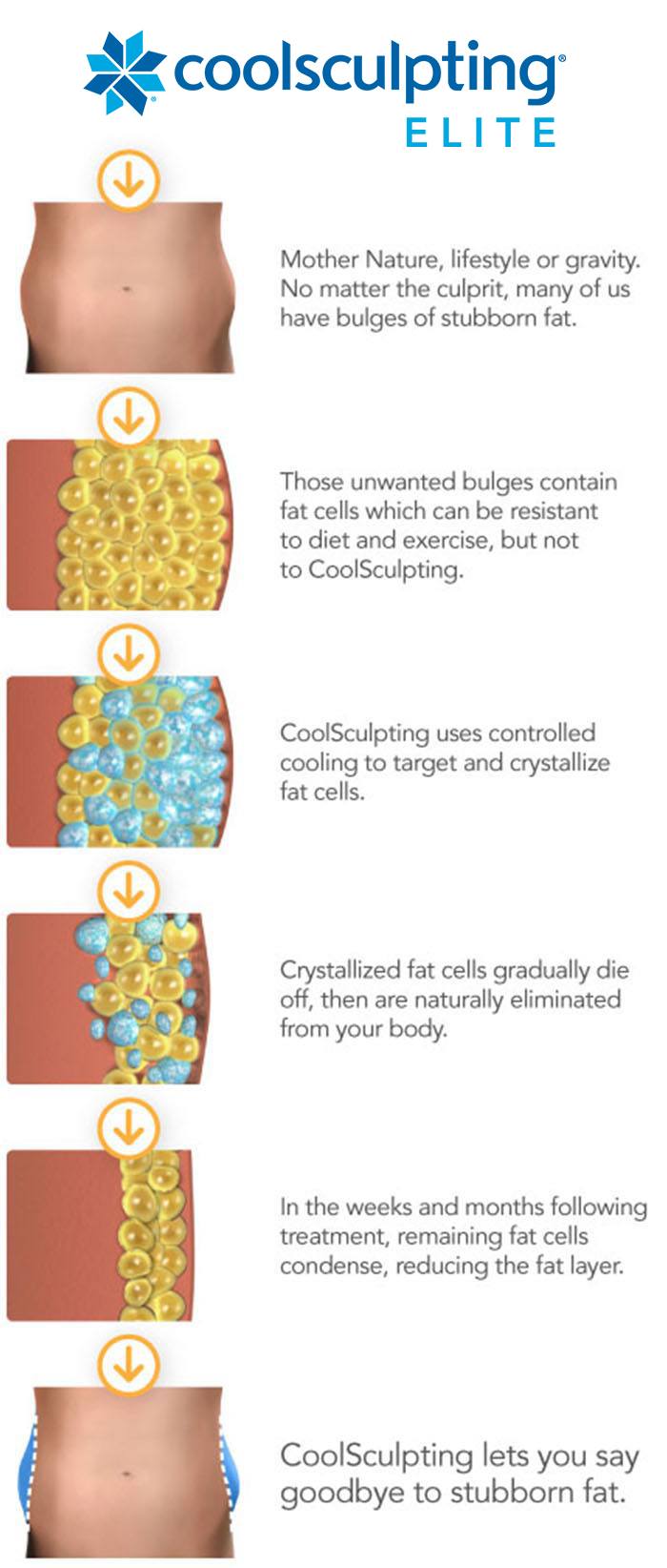 Illustration of how the fat cells look and react to a CoolSculpting treatment.