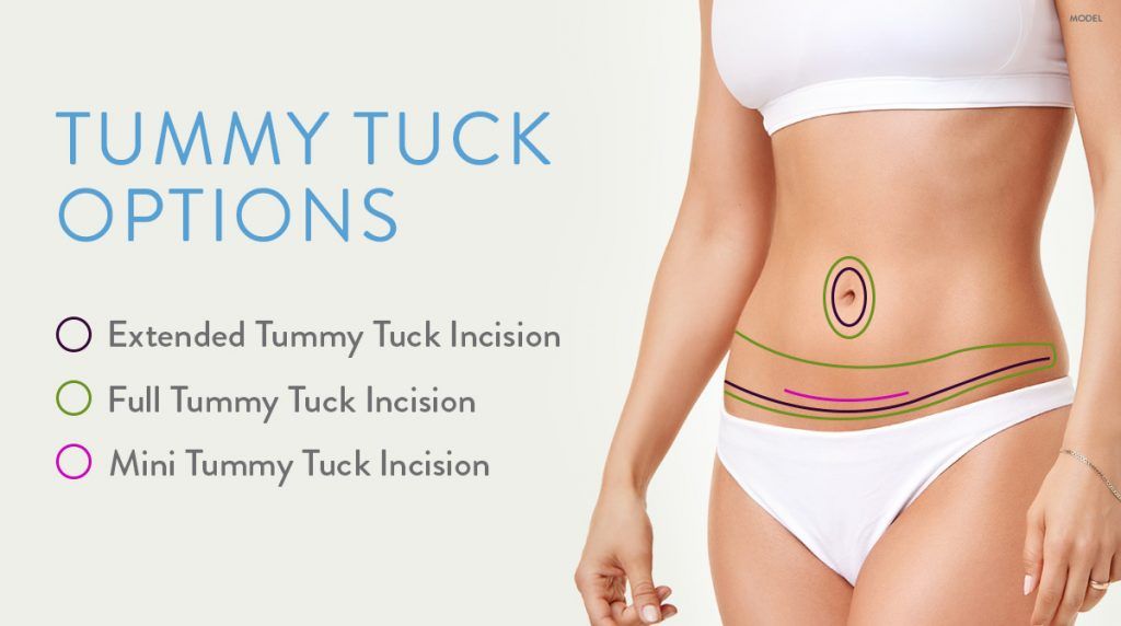 Diagram of the different areas associated with an extended tummy tuck, full tummy tuck, and mini tummy tuck