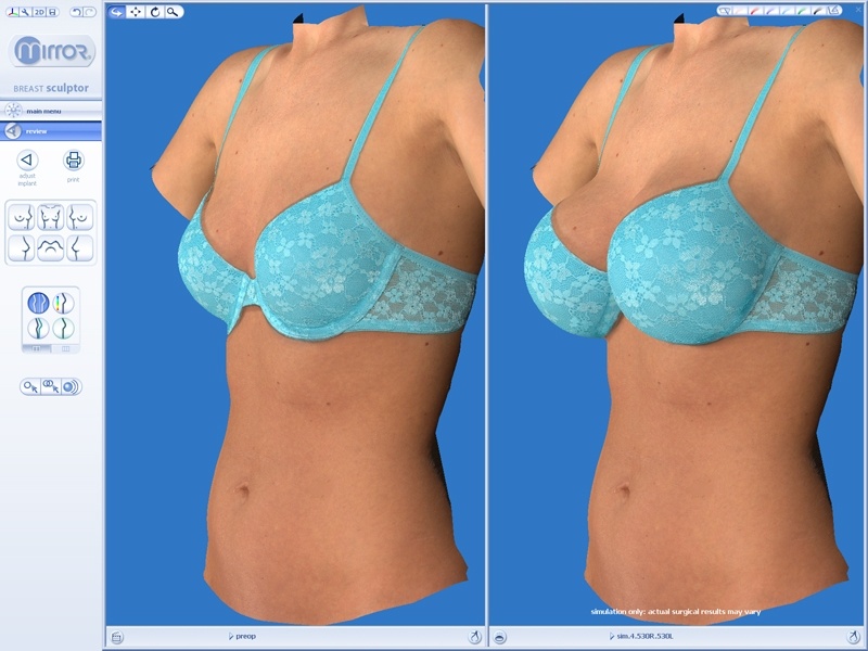 Vectra breast 3D image