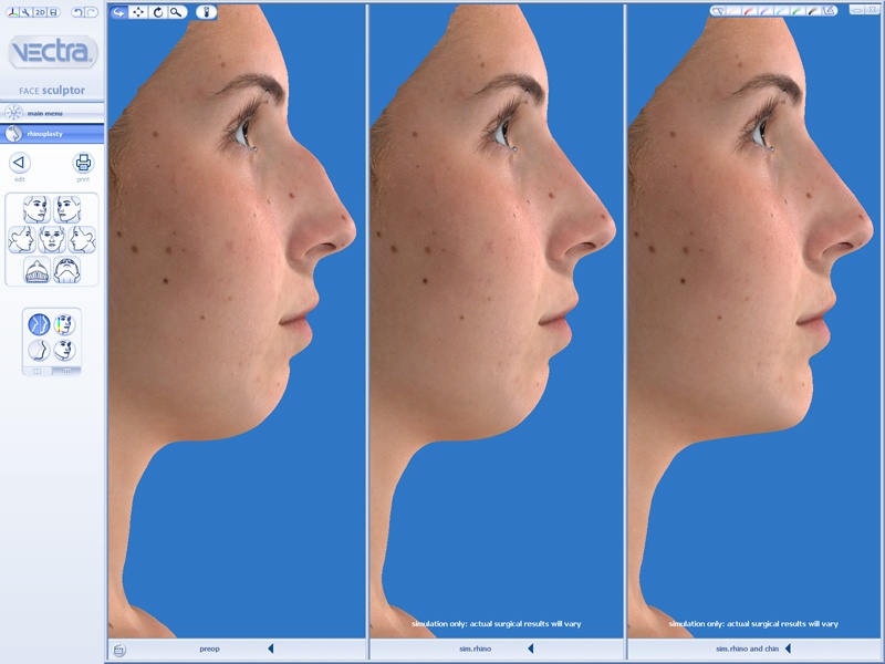Vectra face 3D