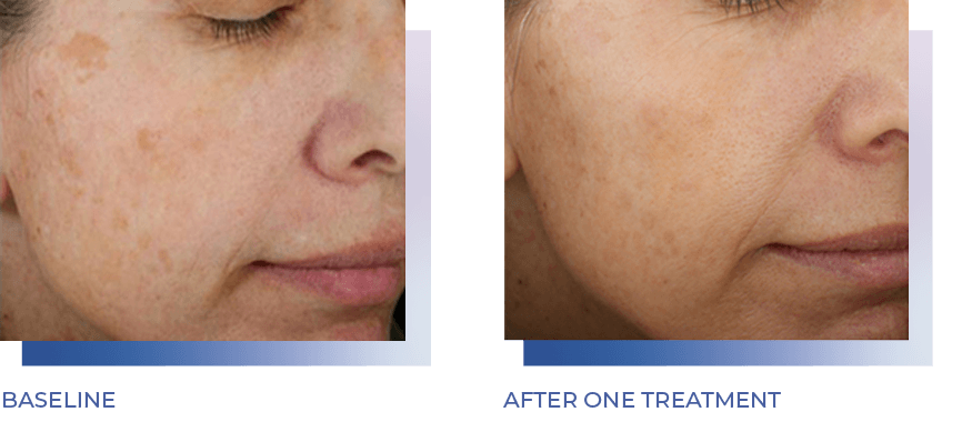 woman's face before and after one Glacial treatment
