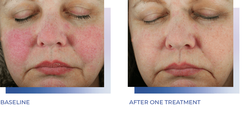 woman's face before and after one Glacial treatment
