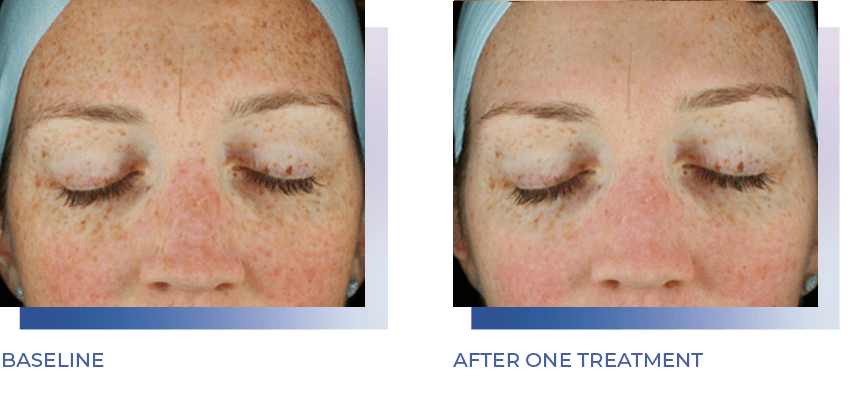 woman's face before and after one glacial treatment