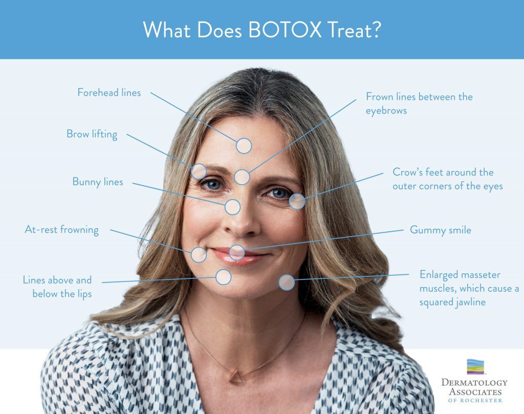 Instagraphic of "What Does BOTOX treat?"