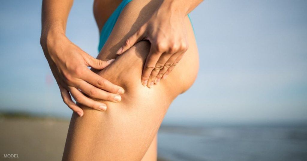 Woman in bikini (model) pinching thigh to show cellulite