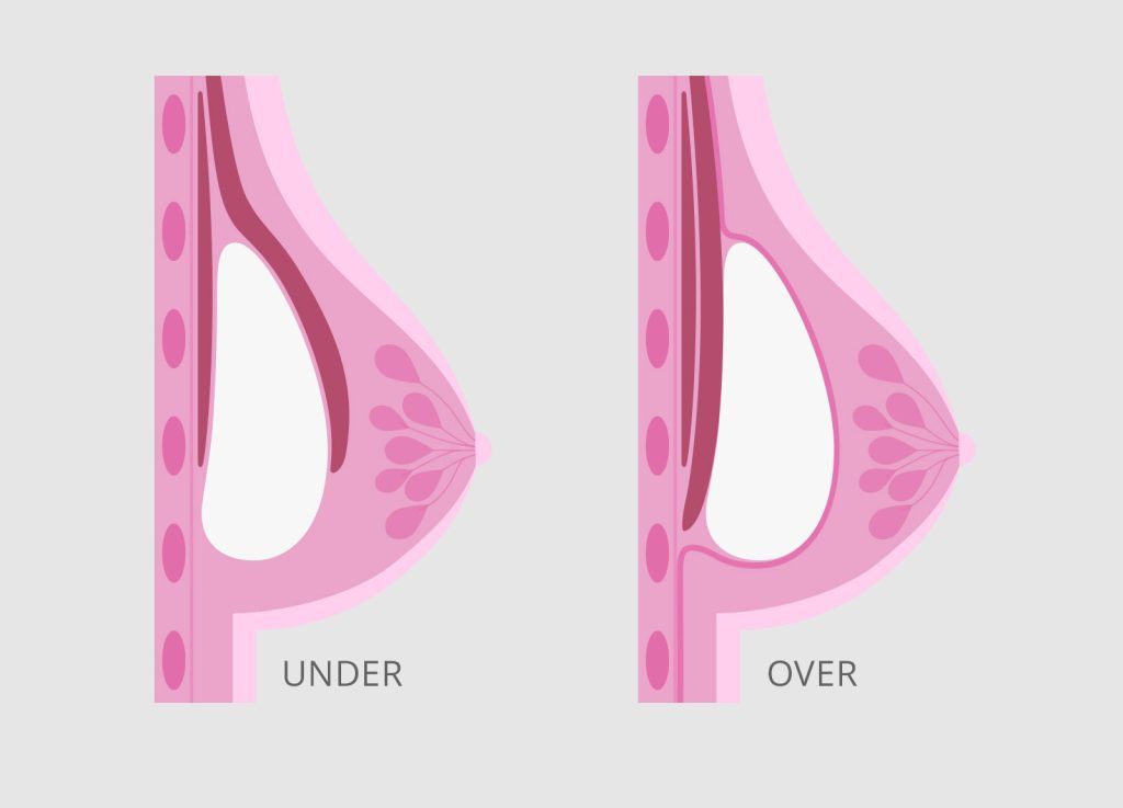 Diagram showing the placement of implants in the subglandular vs. submuscular position.