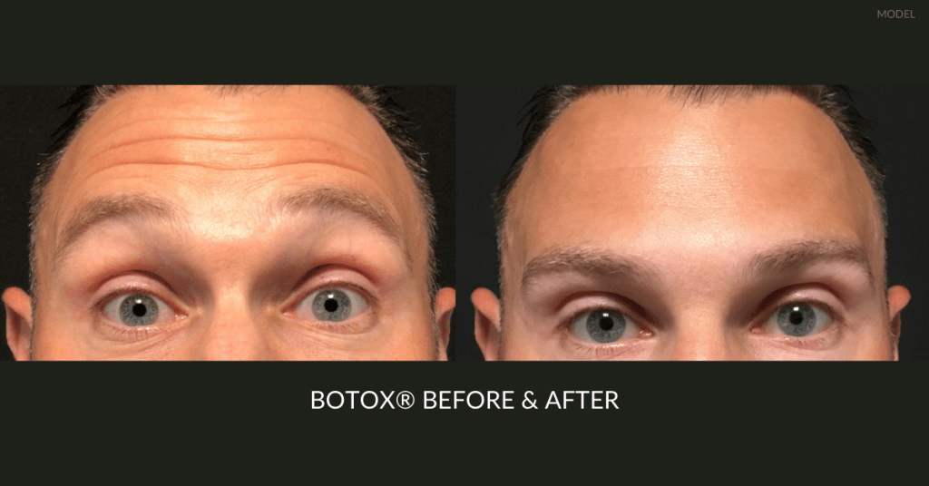 BOTOX before and after image from Dermatology Associates of Rochester
