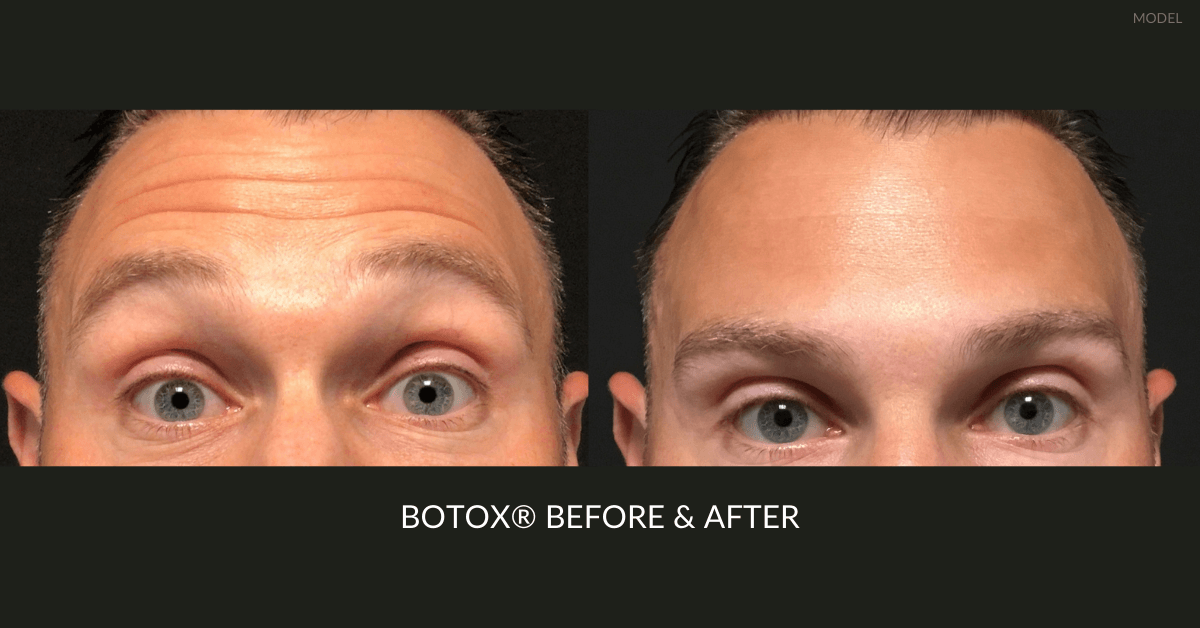 Botox Ogden